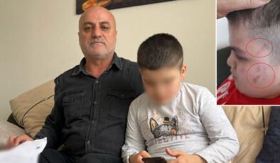 Öğretmen açığa alındı! Otizmli çocukta 54 morluk!