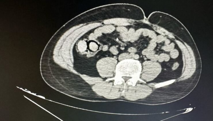 Midelerinde uyuşturucu çıkan 2 şüpheli, tutuklandı