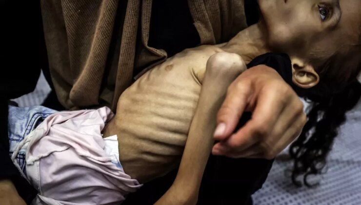 İnsanlığı utandıracak görüntüler! Gazzeli Meryem yavaş yavaş ölüyor
