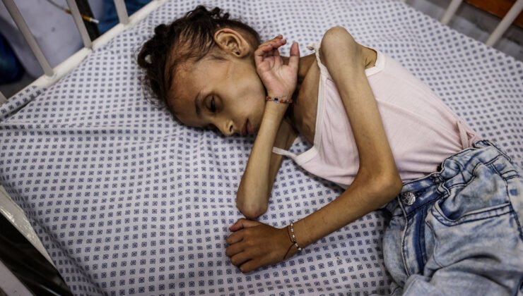 İsrail’in kıtlığa sürüklediği Gazze’de 9 yaşındaki Meryem, 25 kilodan 10 kiloya düştü